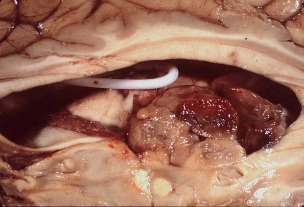 17A1 Tuberous sclerosis (WUMS Case) 3A