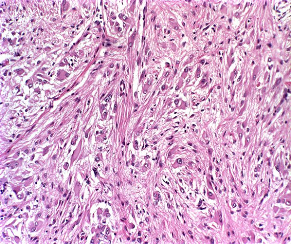 17A3 Tuberous sclerosis (WUMS Case) candle guttering H&E