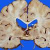 18A1 Tuberous sclerosis (Case 18) 53d (2)