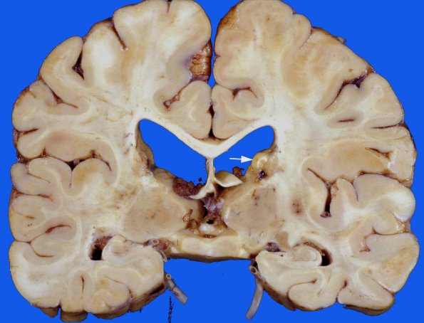 18A1 Tuberous sclerosis (Case 18) 53d (2)