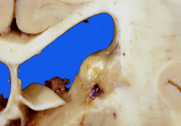 18A2 Tuberous sclerosis (Case 18)53e