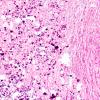 18B2 Tuberous sclerosis (Case 18) H&E 53e (2)