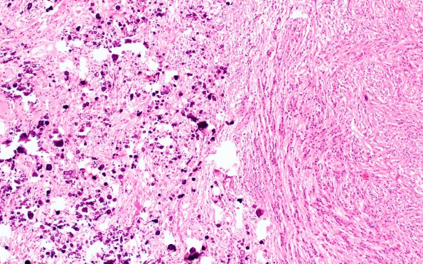 18B2 Tuberous sclerosis (Case 18) H&E 53e (2)