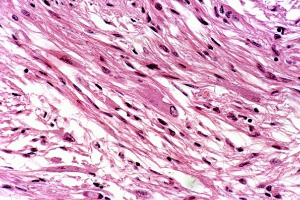 18B4 Tuberous sclerosis (Case 18) 55b