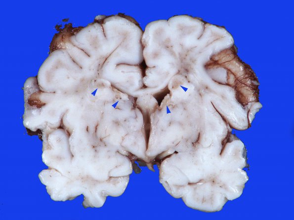 19A1 Tuberous Sclerosis (Case 19) 1 copy