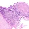 19B2 Tuberous Sclerosis (Case 19) H&E N11 1