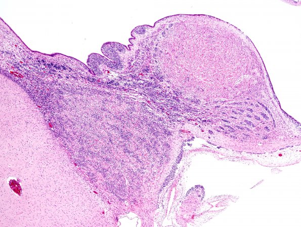 19B2 Tuberous Sclerosis (Case 19) H&E N11 1