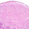 19B3 Tuberous Sclerosis (Case 19) H&E N11 3