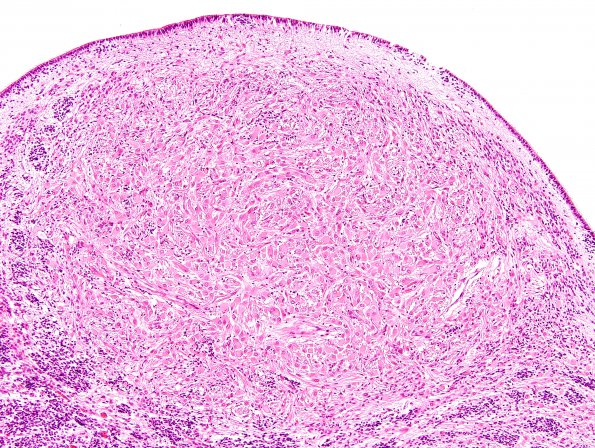 19B3 Tuberous Sclerosis (Case 19) H&E N11 3