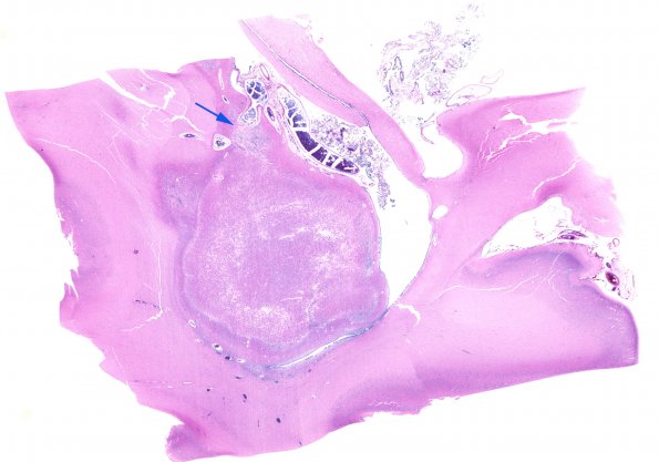 19C1 Tuberous Sclerosis (Case 19) H&E N14 WM copy