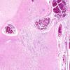 19C2 Tuberous Sclerosis (Case 19) H&E N14 1