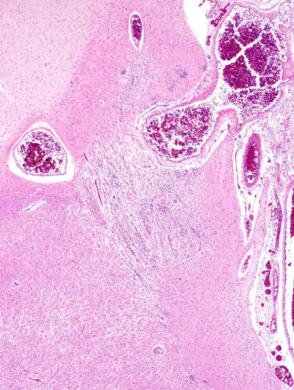 19C2 Tuberous Sclerosis (Case 19) H&E N14 1