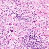 19C3 Tuberous Sclerosis (Case 19) H&E N14 3