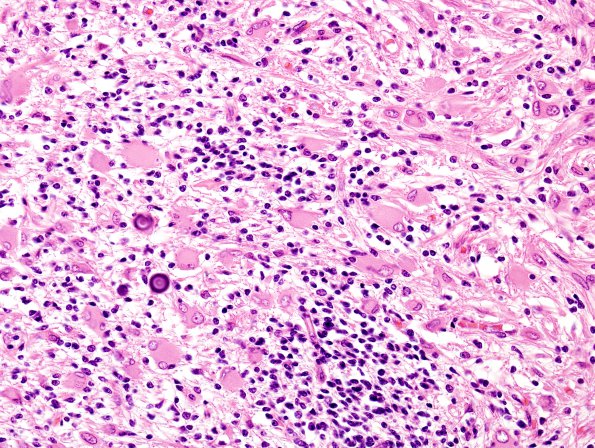 19C3 Tuberous Sclerosis (Case 19) H&E N14 3