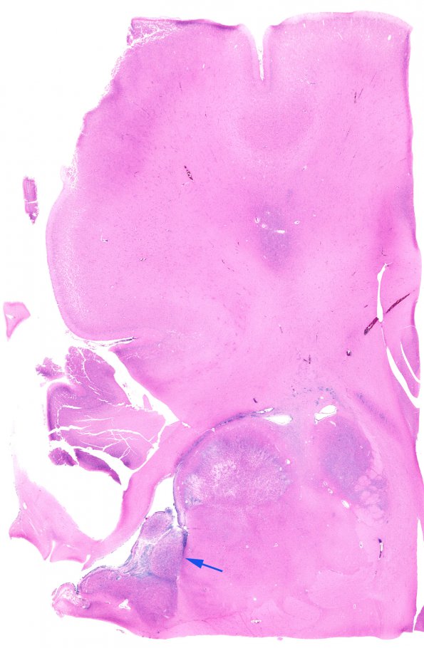 19D1 Tuberous Sclerosis (Case 19) H&E N12 whole mount copy