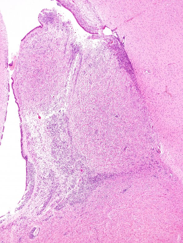 19D2 Tuberous Sclerosis (Case 19) H&E N12 2