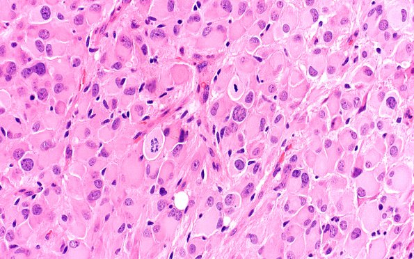 1B6 SEGA (Case 1) H&E mitoses