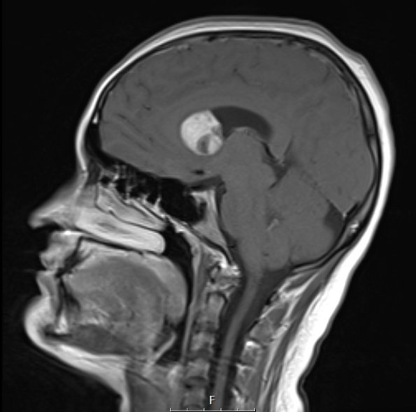 20A5 SEGA (Case 20) Sagittal T1W - Copy