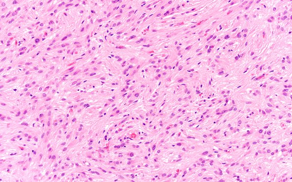 21B6 SEGA (Case 21) H&E 20X 3