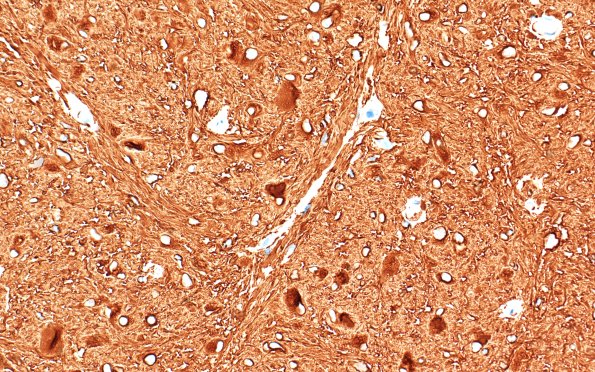 21C2 SEGA (Case 21) GFAP 40X 1