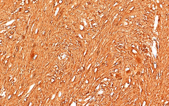 21C3 SEGA (Case 21) GFAP 40X 2