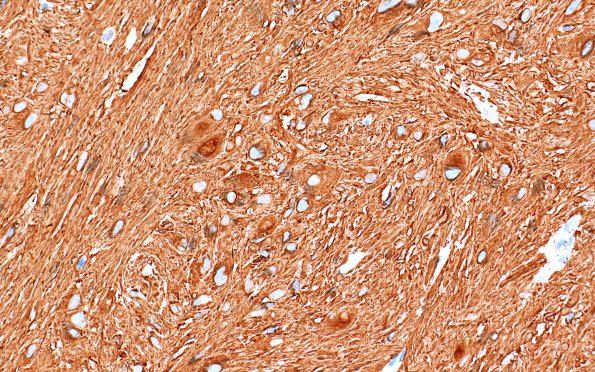 21C4 SEGA (Case 21) GFAP 40X 3