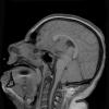 2A1 Astrocytoma, SEGA (Case 2) T1 - Copy