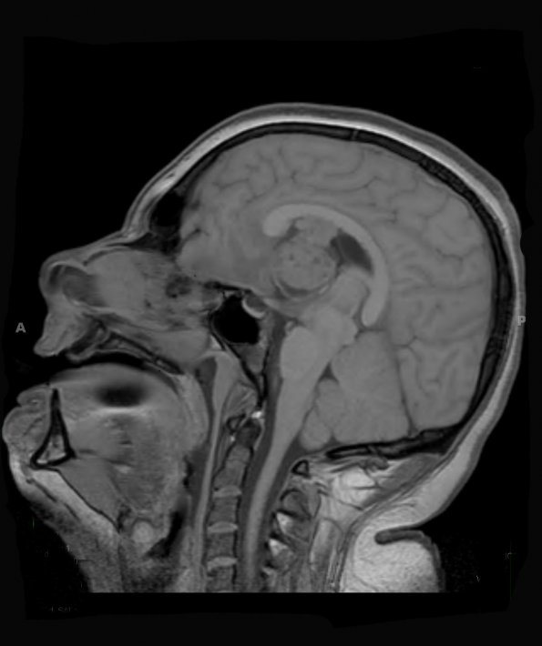 2A1 Astrocytoma, SEGA (Case 2) T1 - Copy