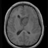 2A2 Astrocytoma, SEGA (Case 2) T1 (4) - Copy - Copy