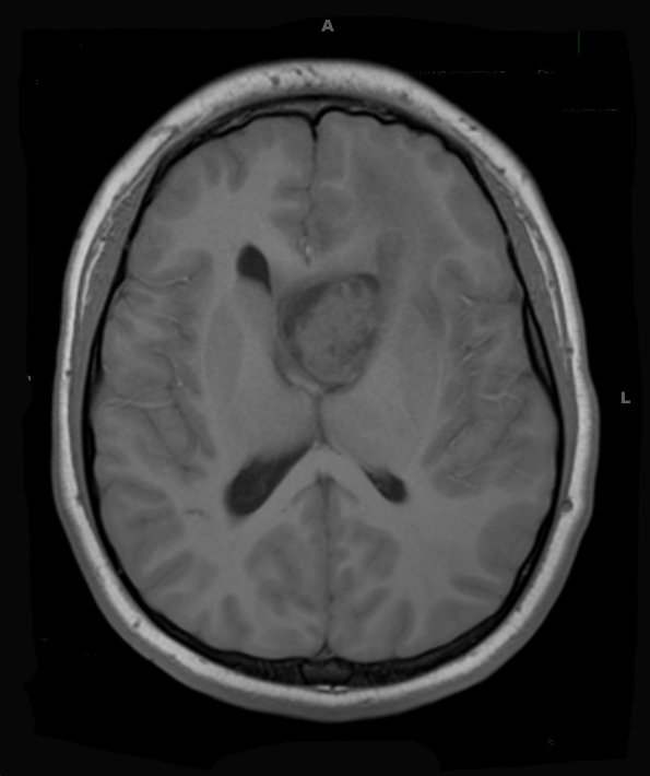 2A2 Astrocytoma, SEGA (Case 2) T1 (4) - Copy - Copy