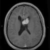 2A3 Astrocytoma, SEGA (Case 2) T1W (2) - Copy