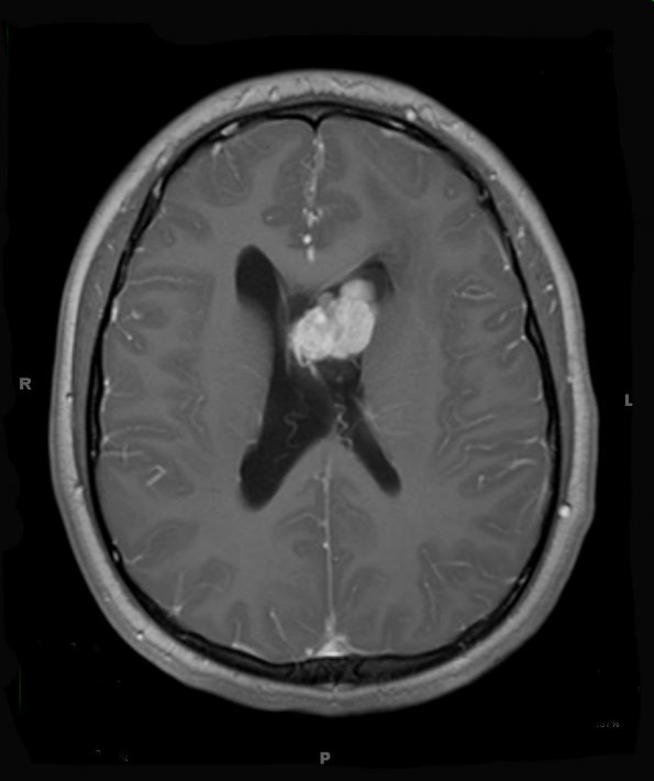 2A3 Astrocytoma, SEGA (Case 2) T1W (2) - Copy