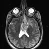 2A4 Astrocytoma, SEGA (Case 2) T2 - Copy