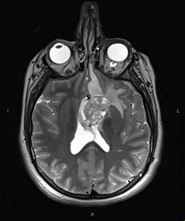 2A4 Astrocytoma, SEGA (Case 2) T2 - Copy