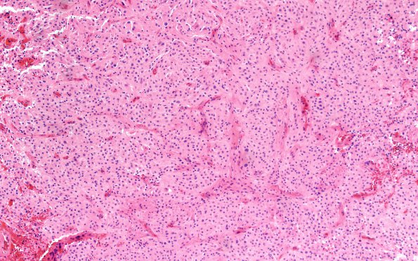 2B1 Astrocytoma, SEGA (Case 2) Area A H&E 10X