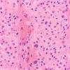 2B5 Astrocytoma, SEGA (Case 2) Area A H&E 40X