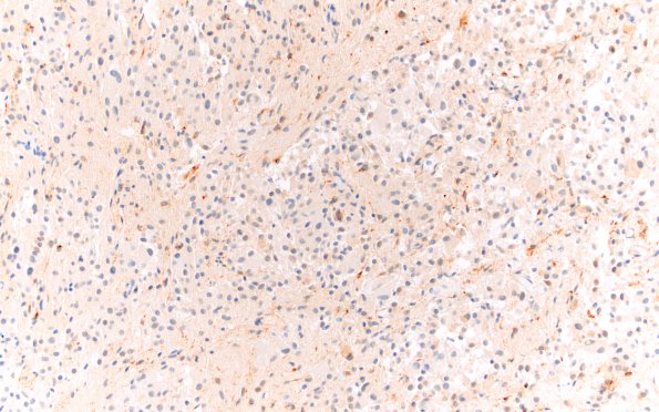 2D1 Astrocytoma, SEGA (Case 2) Area A SYN 20X