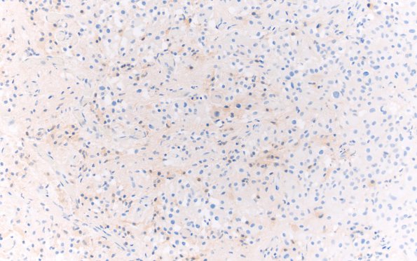 2D2 Astrocytoma, SEGA (Case 2) Area A Chromogranin 20X