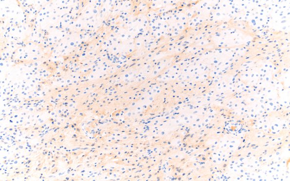 2D3 Astrocytoma, SEGA (Case 2) Area A NF 20X