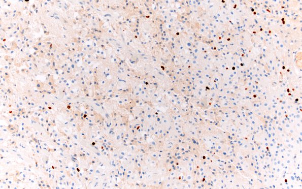 2E Astrocytoma, SEGA (Case 2) Area A Ki67 20X