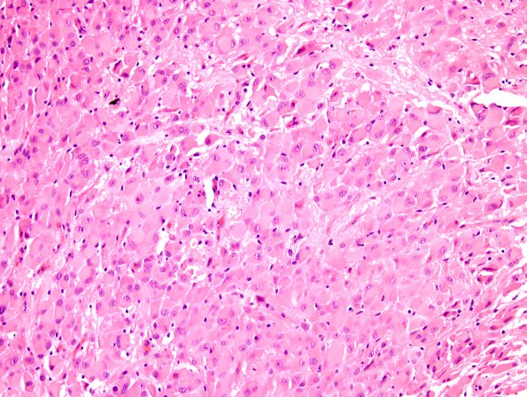 3A2 Astrocytoma, SEGA (Case 3) H&E 2