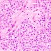 3A5 Astrocytoma, SEGA (Case 3) H&E 5