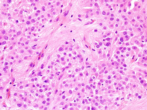 3A5 Astrocytoma, SEGA (Case 3) H&E 5