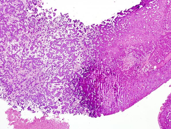 3A6 Astrocytoma, SEGA (Case 3) H&E 7