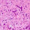 3A9 Astrocytoma, SEGA (Case 3) H&E 13