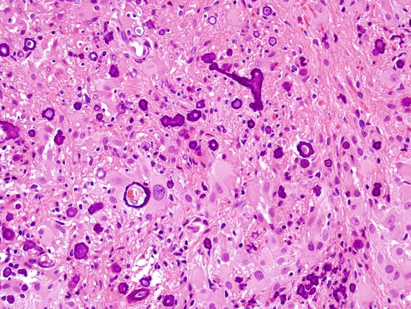 3A9 Astrocytoma, SEGA (Case 3) H&E 13