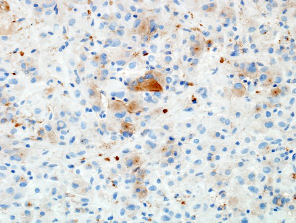 3C Astrocytoma, SEGA (Case 3) SYN 2