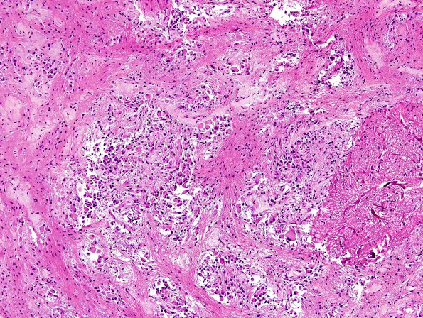 4A5 Astrocytoma, subependymal giant cell (SEGA Case 4) H&E 7.jpg