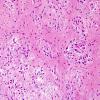 4A6 Astrocytoma, subependymal giant cell (SEGA Case 4) H&E 8.jpg