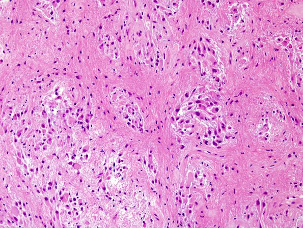 4A6 Astrocytoma, subependymal giant cell (SEGA Case 4) H&E 8.jpg